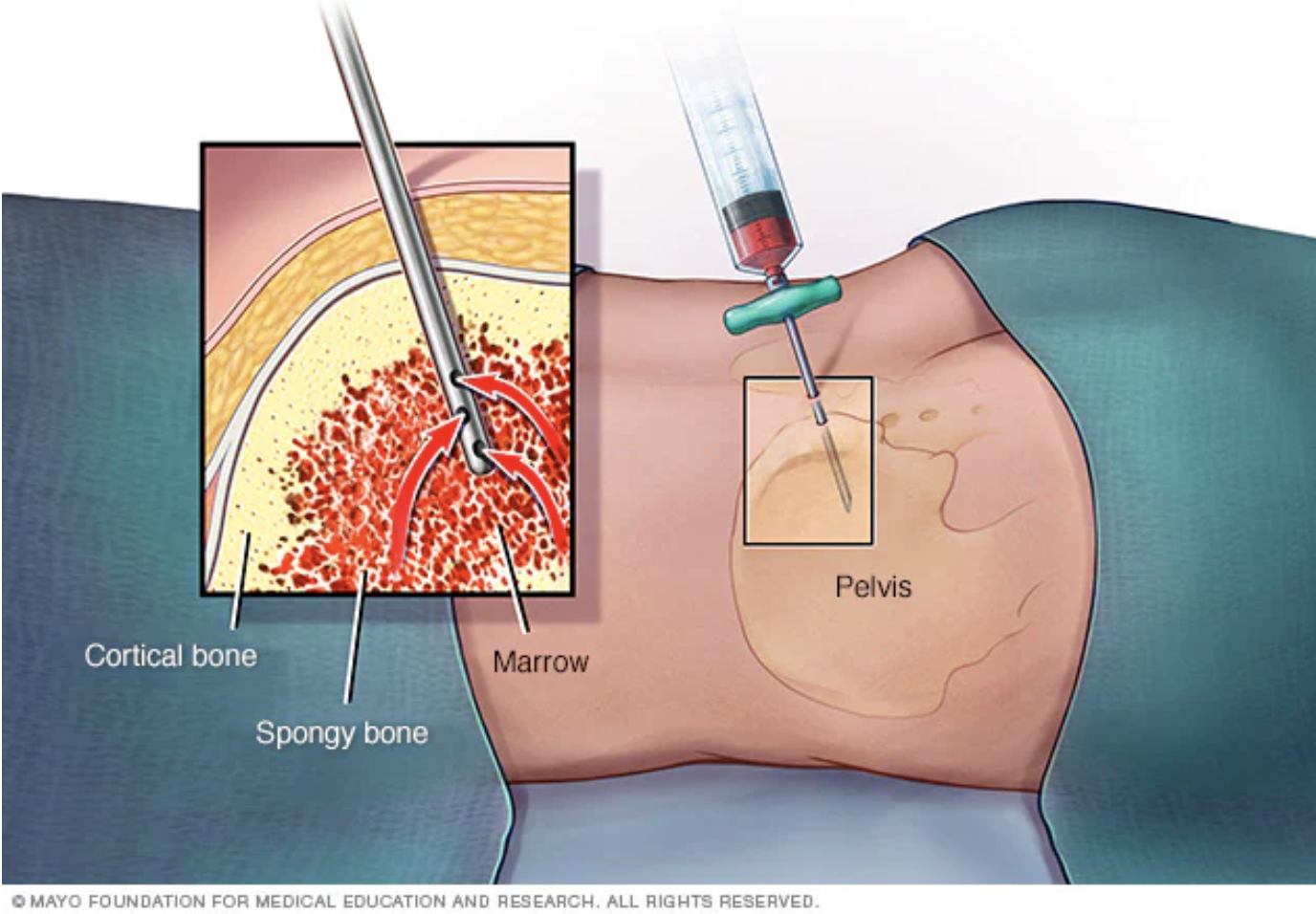 5 Magical Benefits Of Bone Marrow Aspiration 5 Magical Benefits Of Bone Marrow Aspiration