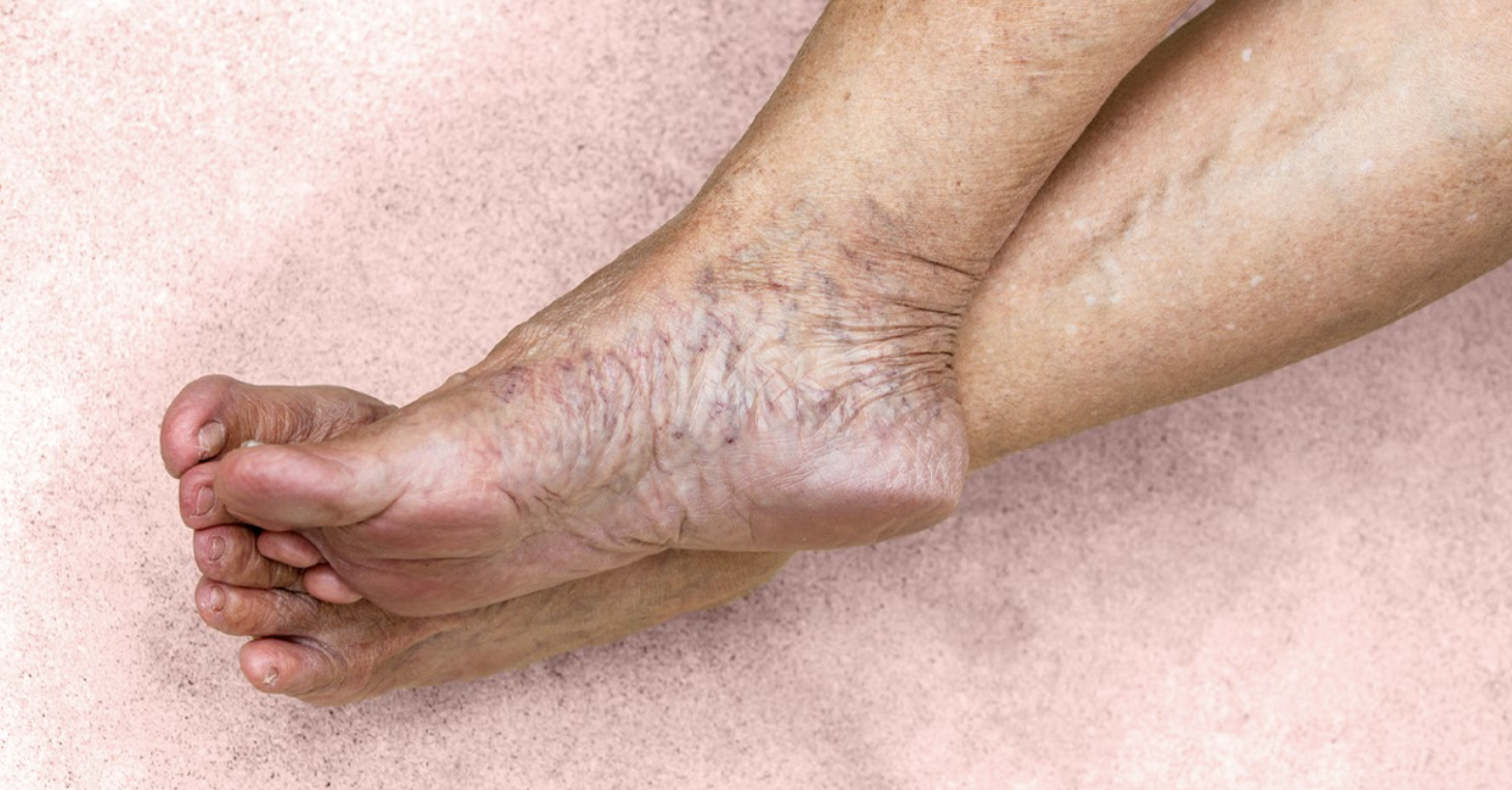 Lifestyle Changes You Must Make To Prevent Venous Insufficiency